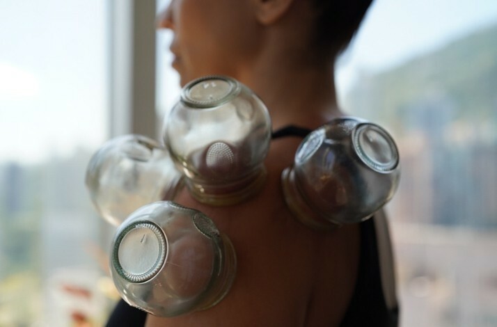 A person is having a  cupping therapy at Balance Health